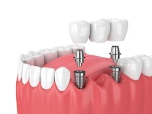 implant supported dental bridge in Cary North Carolina
