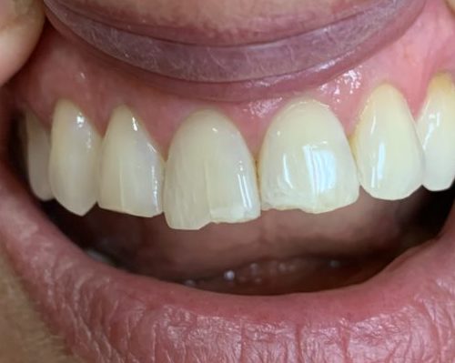 before dental care