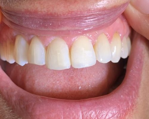 after dental care