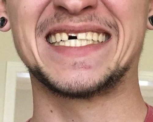before dental care