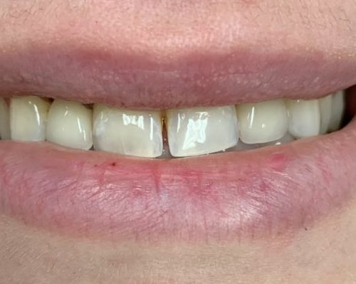 after dental care