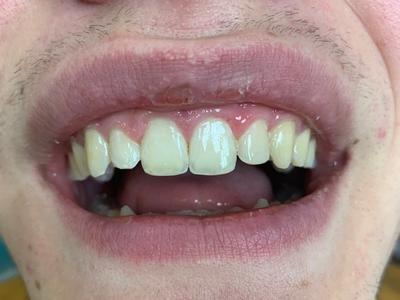 after dental care