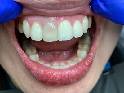 before dental care
