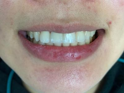 after dental care