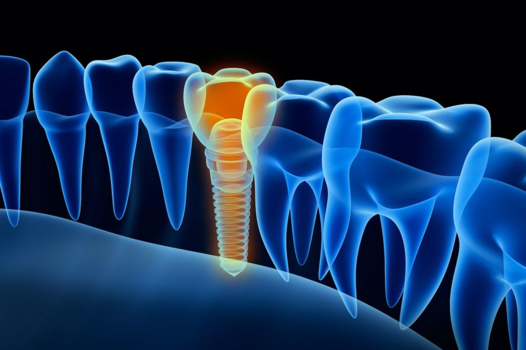 Reedy Creek Family & Cosmetic Dentistry offers dental implants in Cary, NC