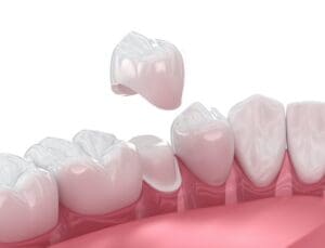 Dentists often recommend dental crowns for various reasons. Crowns serve as protective covers for damaged teeth.