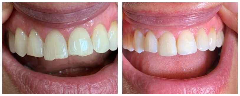 before and after porcelain veneers in Cary NC