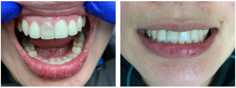 before and after restoring a dental crown in Cary NC